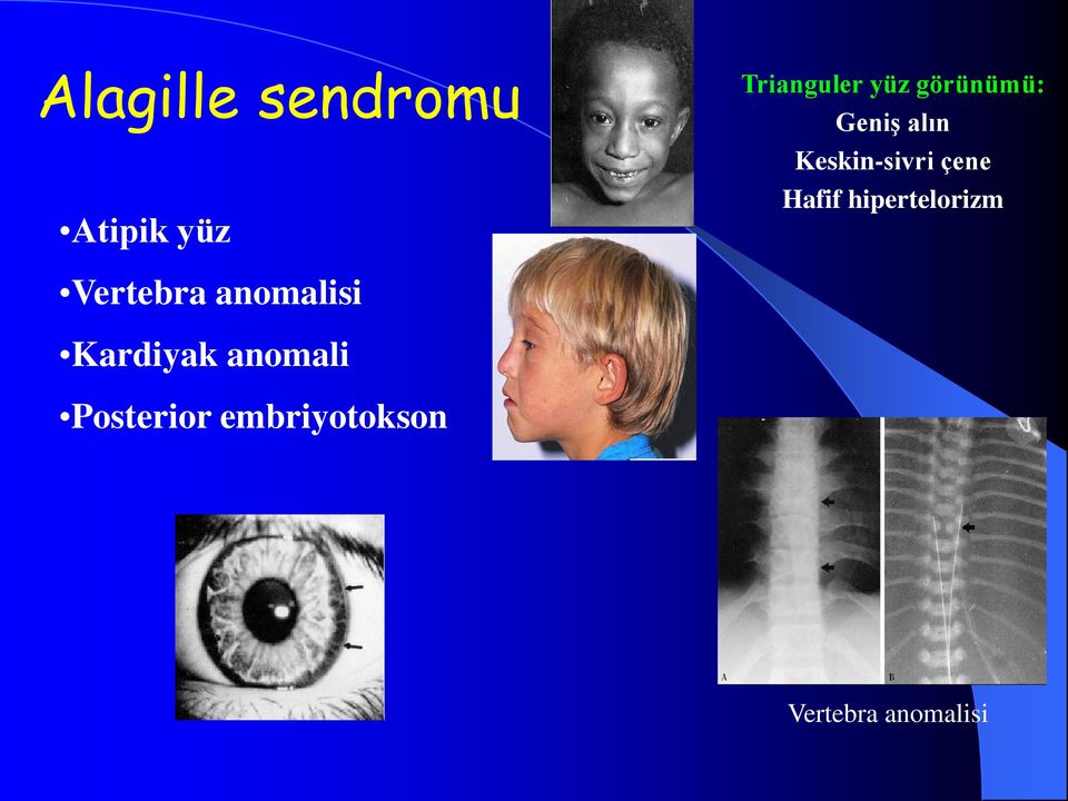 hipertelorizm Vertebra anomalisi Kardiyak