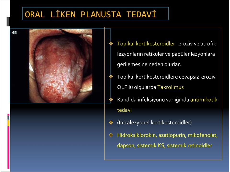 Topikal kortikosteroidlere cevapsız eroziv OLP lu olgularda Takrolimus Kandida infeksiyonu