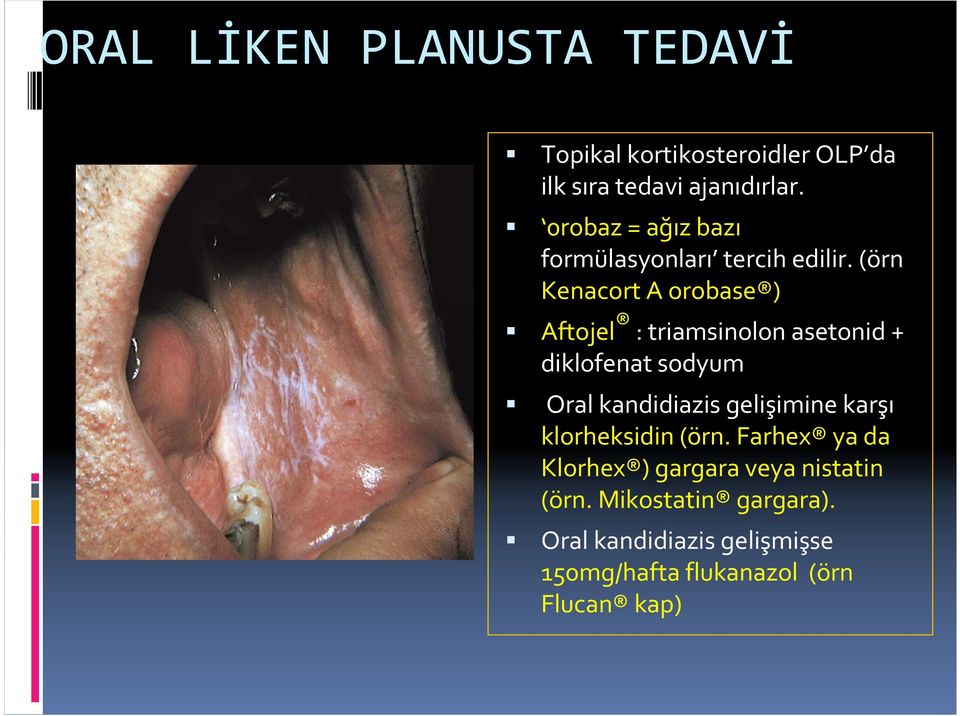 (örn Kenacort A orobase ) Aftojel : triamsinolon asetonid + diklofenat sodyum Oral kandidiazis