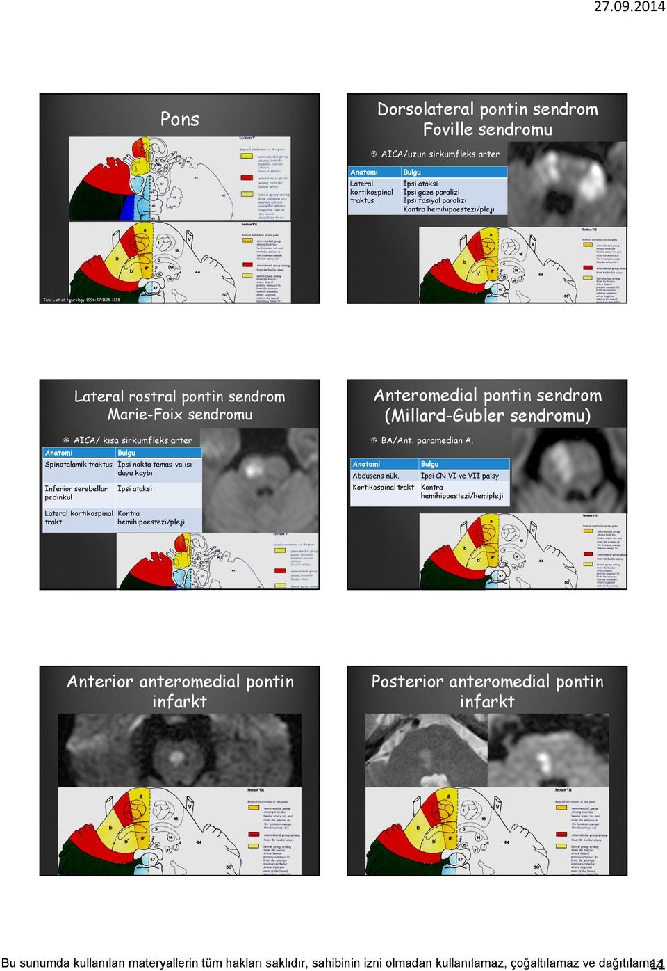 Neurology 1996:47:1125-1135 Lateral rostral pontin sendrom Marie-Foix sendromu AICA/ kısa sirkumfleks arter Spinotalamik traktus İnferior serebellar pedinkül İpsi nokta temas