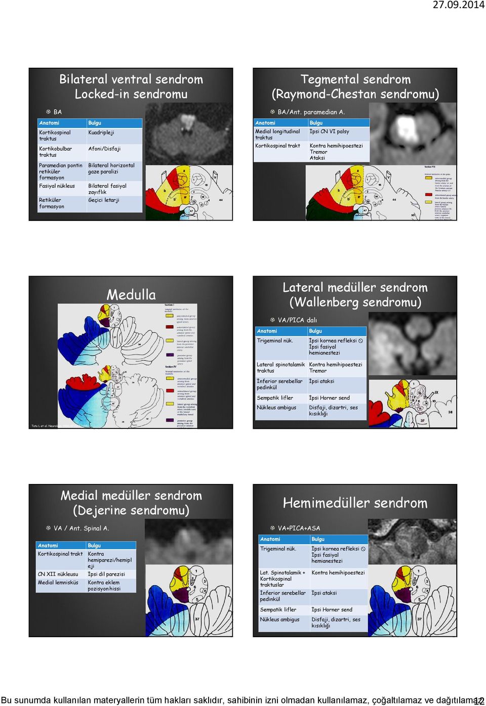 İpsi CN VI palsy Kontra hemihipoestezi Tremor Ataksi Medulla Lateral medüller sendrom (Wallenberg sendromu) VA/PICA dalı Trigeminal nük.