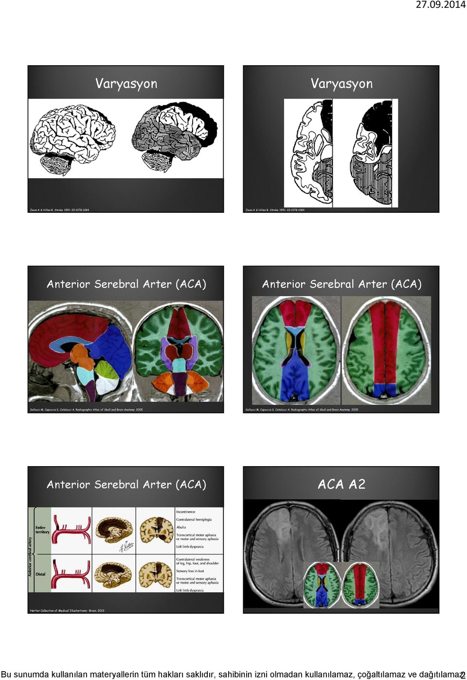 Serebral Arter (ACA) Anterior Serebral Arter (ACA) Anterior