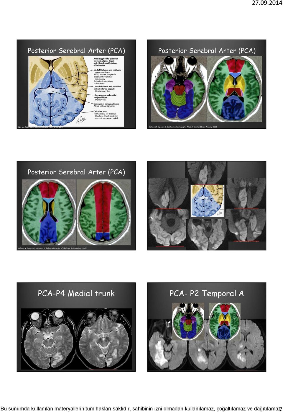 Medical Illustartions : Brain, 2013 Posterior