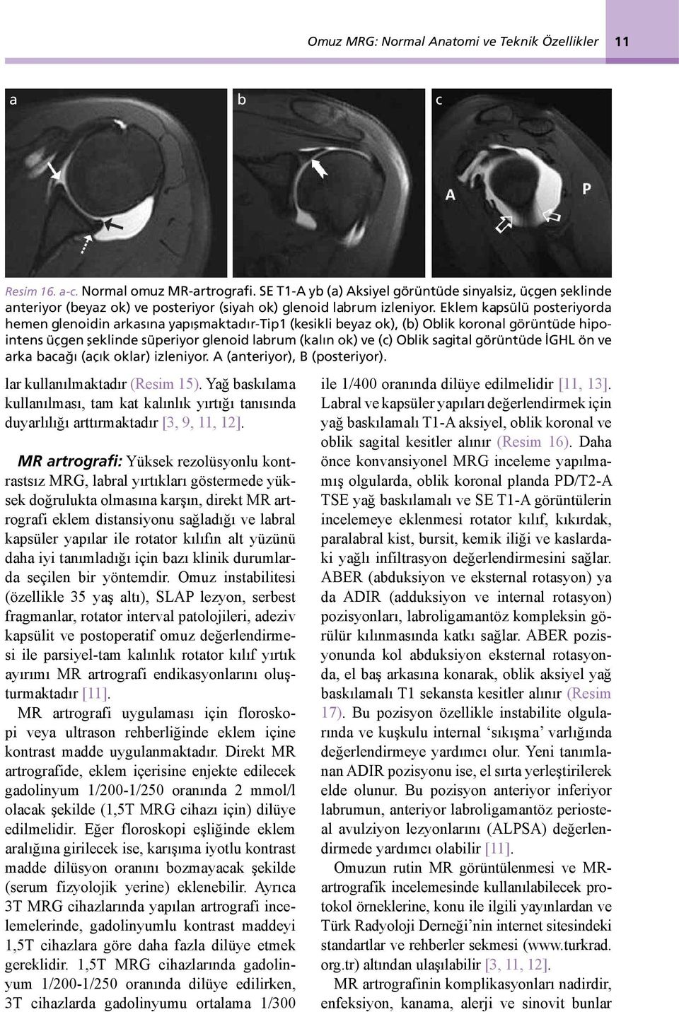 Eklem kapsülü posteriyorda hemen glenoidin arkasına yapışmaktadır-tip1 (kesikli beyaz ok), (b) Oblik koronal görüntüde hipointens üçgen şeklinde süperiyor glenoid labrum (kalın ok) ve (c) Oblik