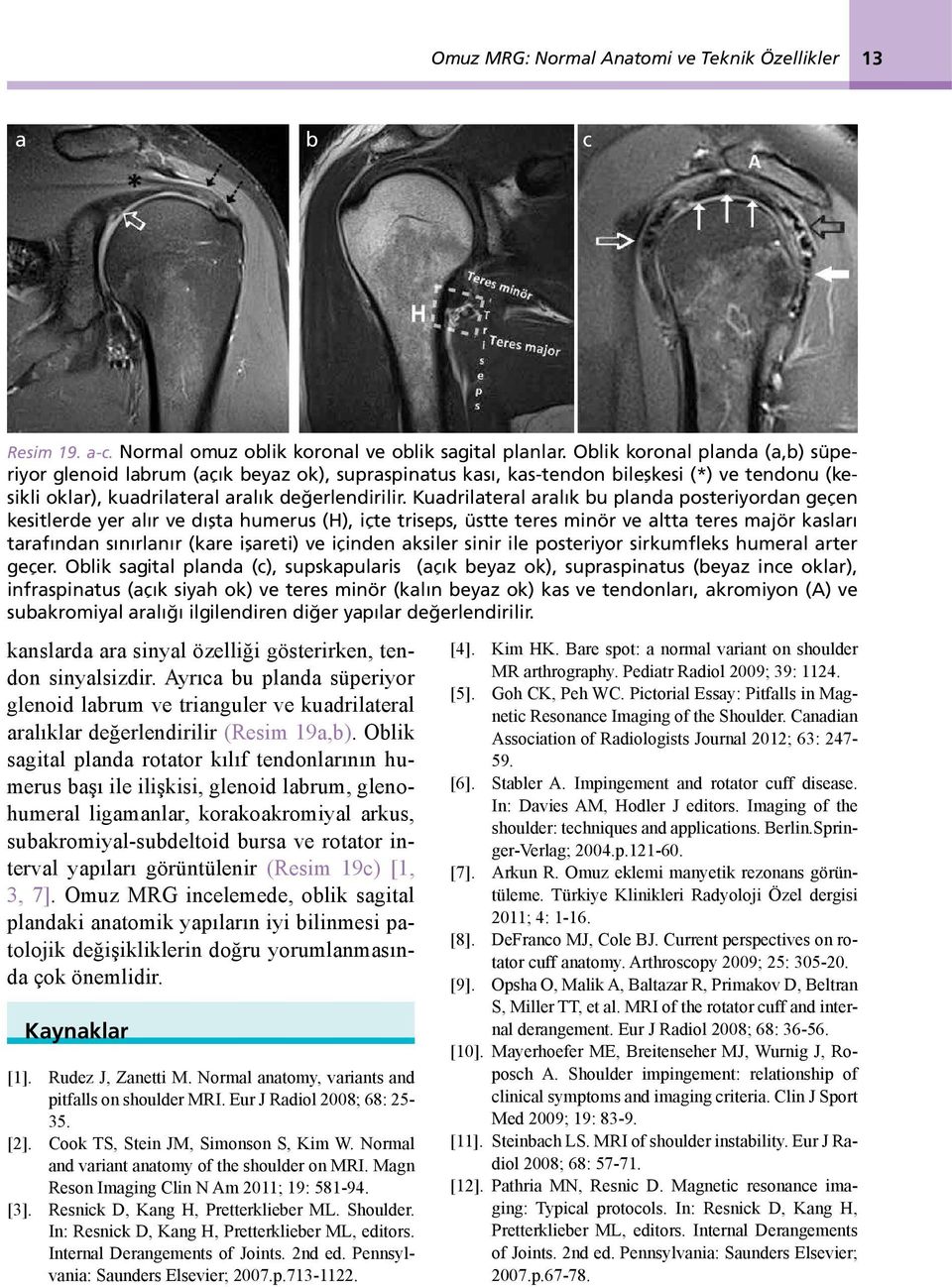 Kuadrilateral aralık bu planda posteriyordan geçen kesitlerde yer alır ve dışta humerus (H), içte triseps, üstte teres minör ve altta teres majör kasları tarafından sınırlanır (kare işareti) ve