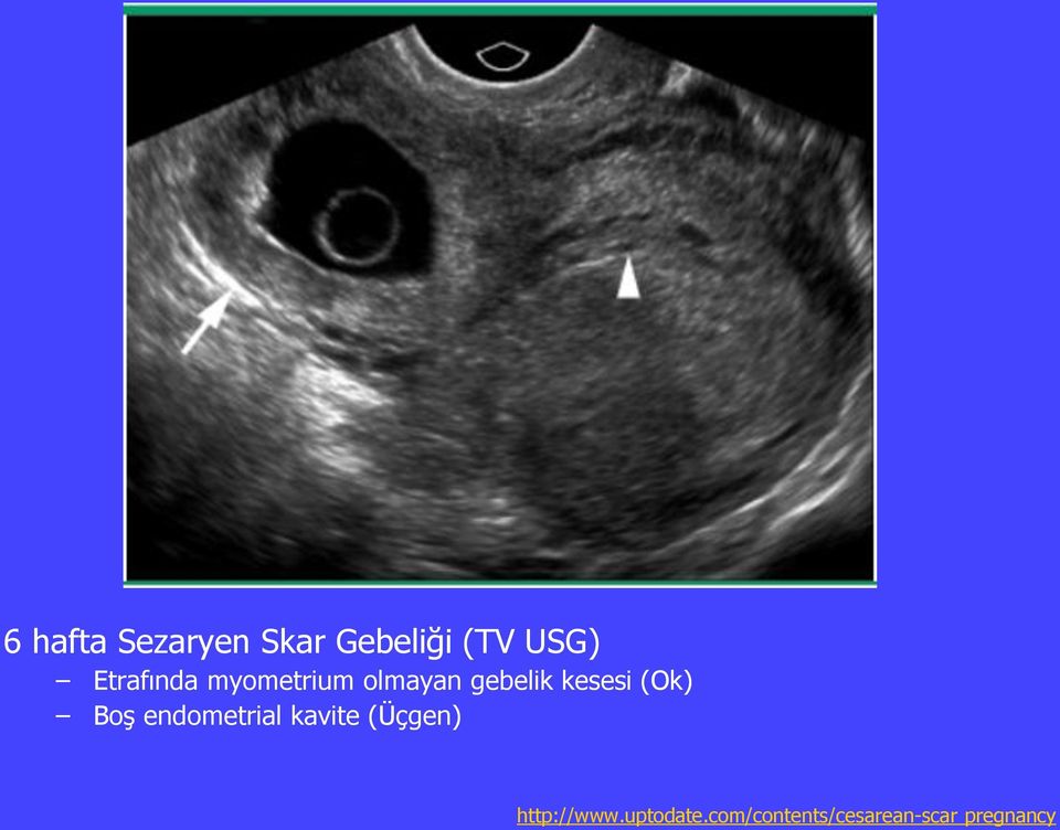 (Ok) Boş endometrial kavite (Üçgen)