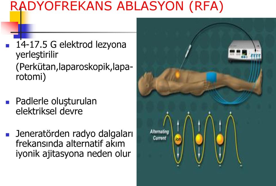 (Perkütan,laparoskopik,laparotomi) Padlerle oluşturulan