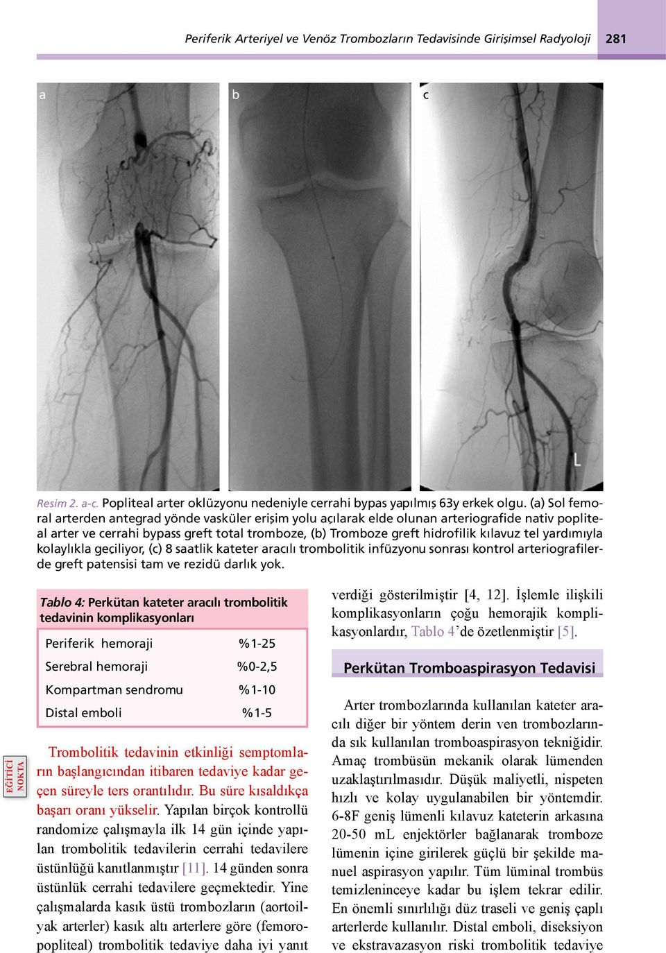 tel yardımıyla kolaylıkla geçiliyor, (c) 8 saatlik kateter aracılı trombolitik infüzyonu sonrası kontrol arteriografilerde greft patensisi tam ve rezidü darlık yok.