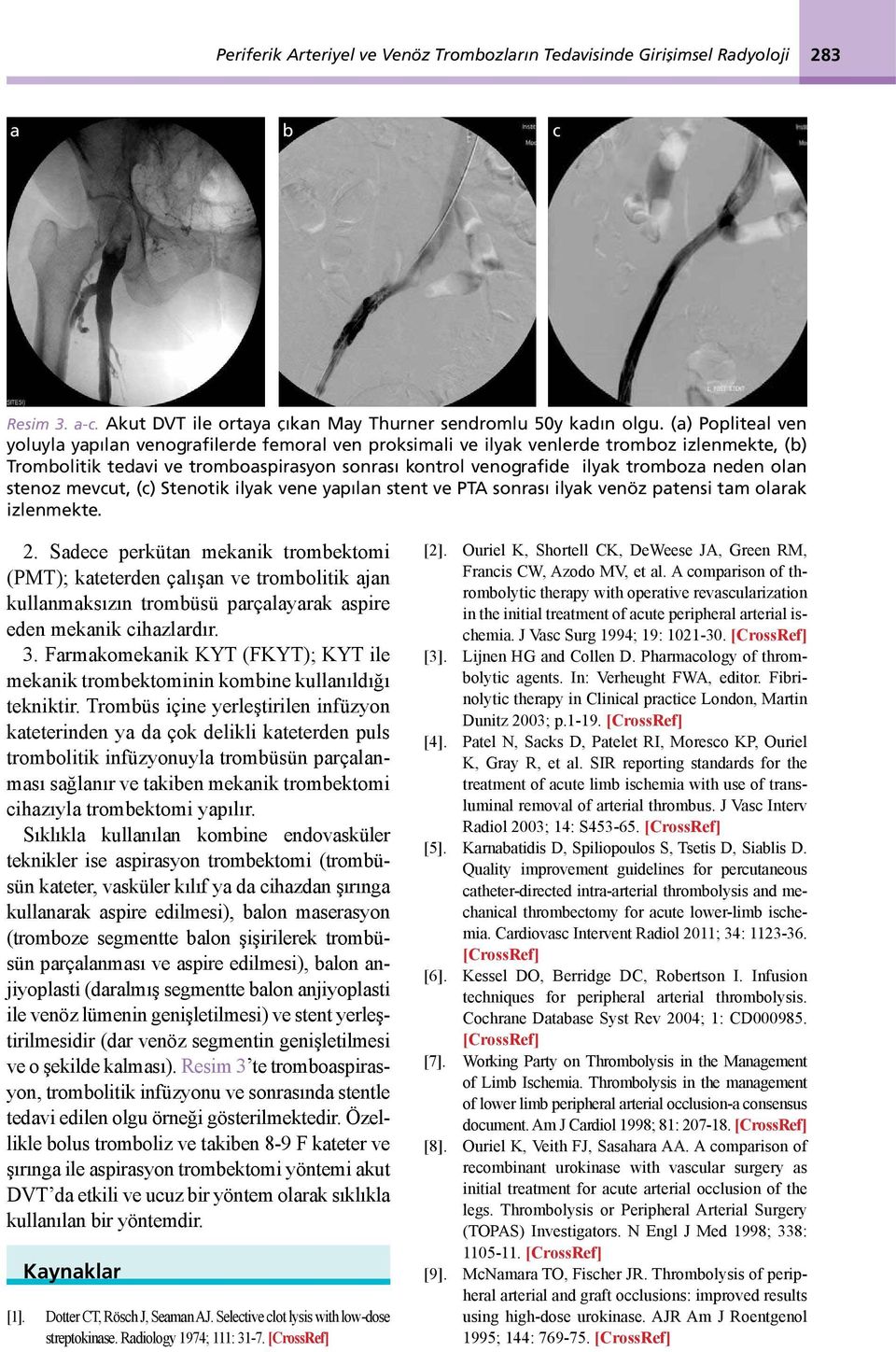neden olan stenoz mevcut, (c) Stenotik ilyak vene yapılan stent ve PTA sonrası ilyak venöz patensi tam olarak izlenmekte. 2.