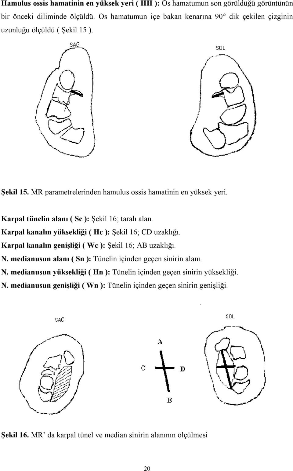 Karpal tünelin alanı ( Sc ): Şekil 16; taralı alan. Karpal kanalın yüksekliği ( Hc ): Şekil 16; CD uzaklığı. Karpal kanalın genişliği ( Wc ): Şekil 16; AB uzaklığı. N.