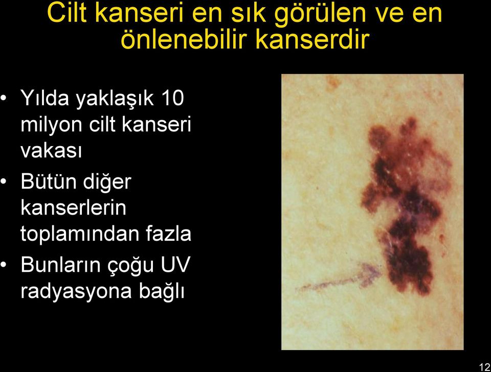 milyon cilt kanseri vakası Bütün diğer