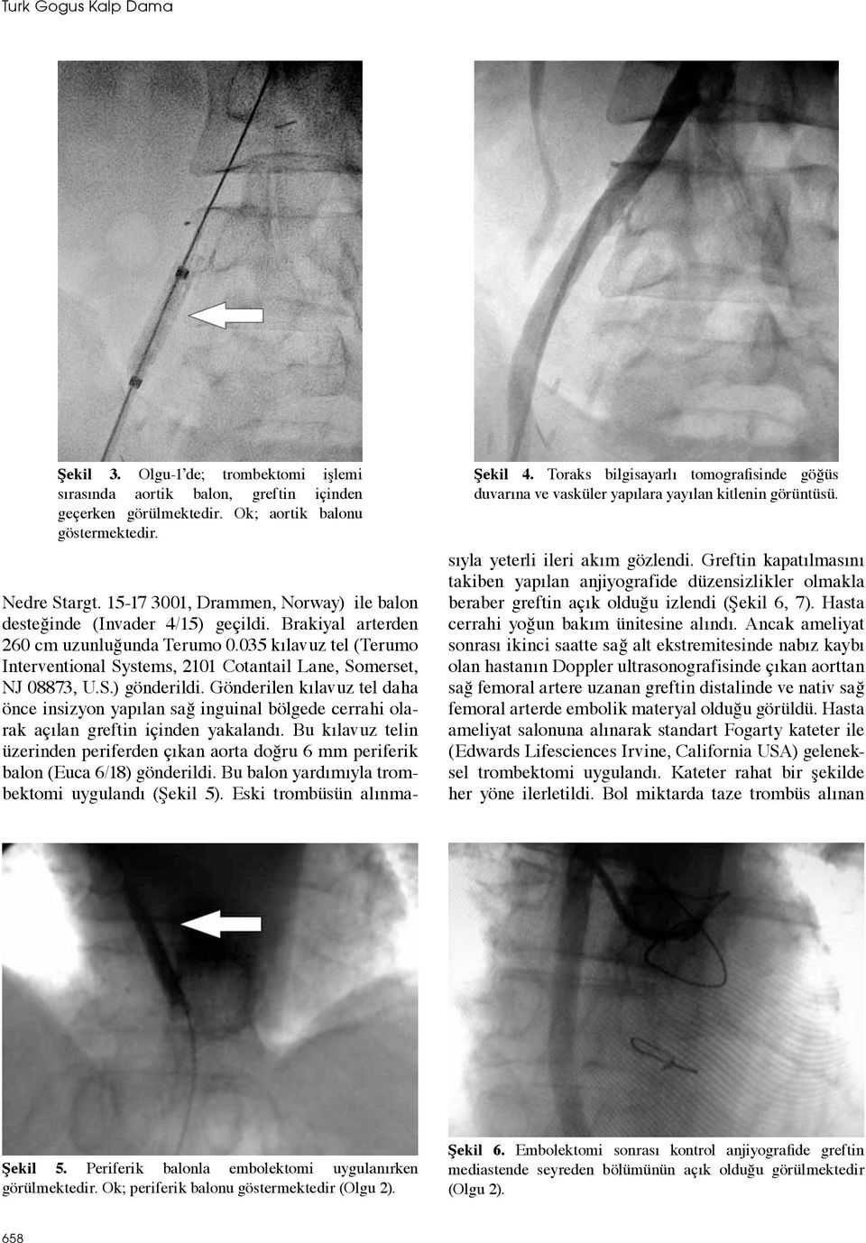 Brakiyal arterden 260 cm uzunluğunda Terumo 0.035 kılavuz tel (Terumo Interventional Systems, 2101 Cotantail Lane, Somerset, NJ 08873, U.S.) gönderildi.