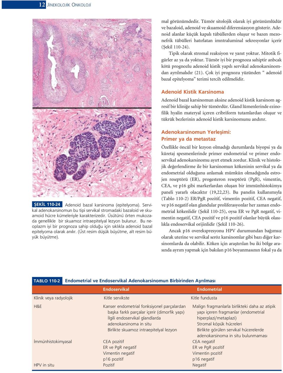Mitotik figürler az ya da yoktur. Tümör iyi bir prognoza sahiptir anbcak kötü prognozlu adenoid kistik yap l servikal adenokarsinomdan ayr lmal d r (21).