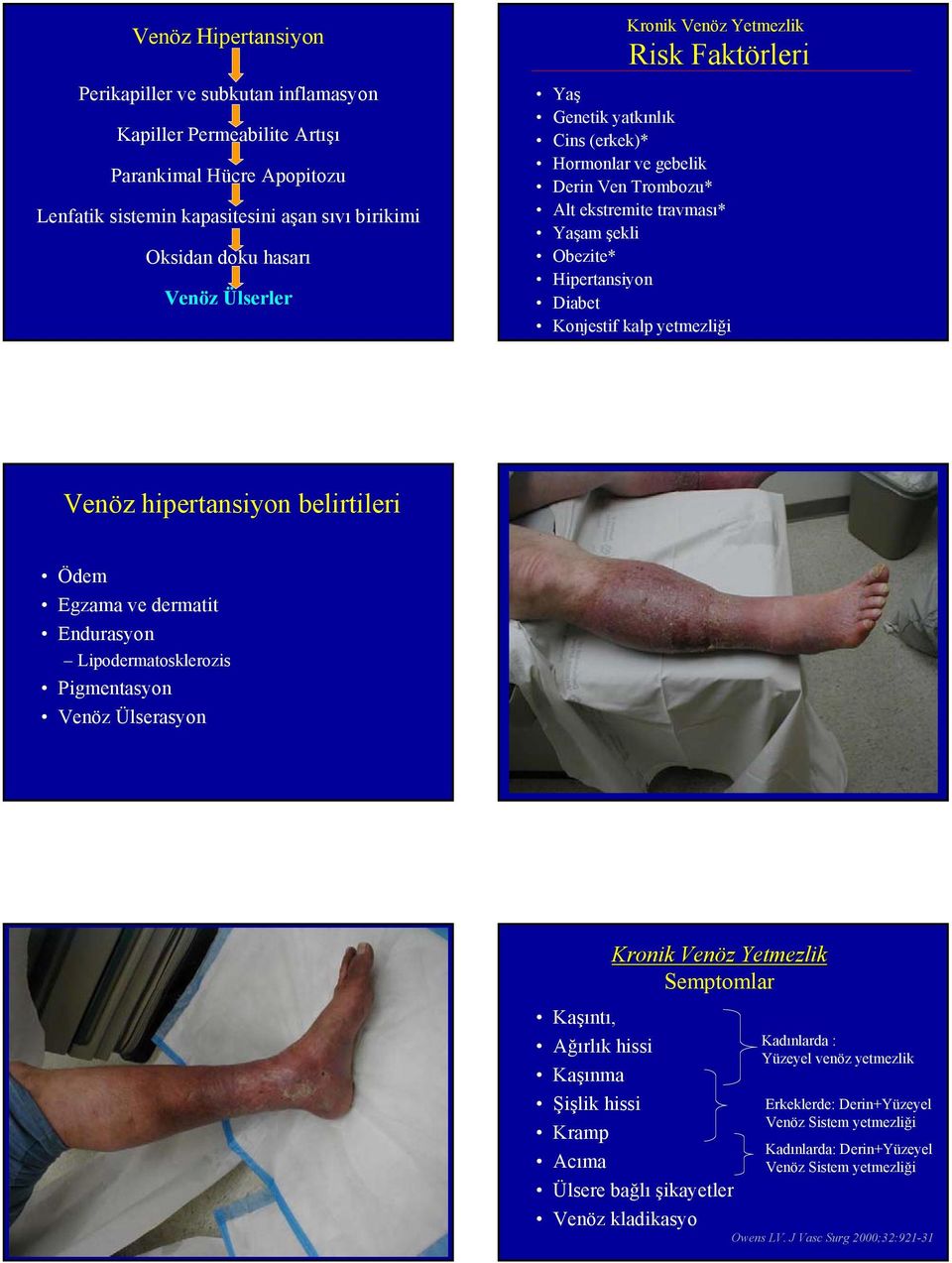 yetmezliği Venöz hipertansiyon belirtileri Ödem Egzama ve dermatit Endurasyon Lipodermatosklerozis Pigmentasyon Venöz Ülserasyon Kronik Venöz Yetmezlik Semptomlar Kaşıntı, Ağırlık hissi Kaşınma