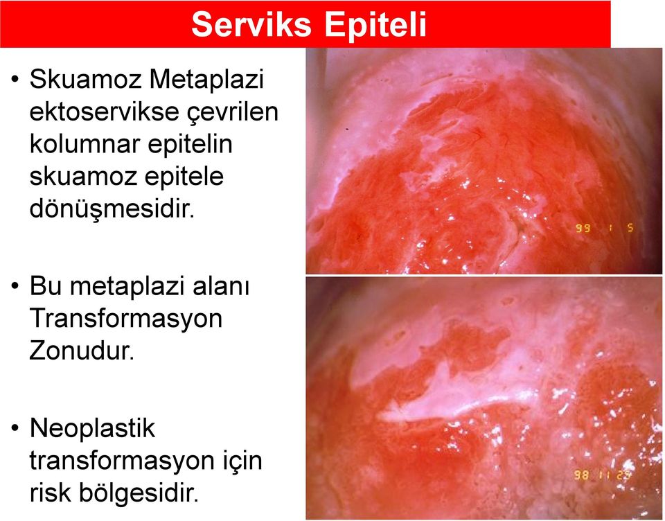 Serviks Epiteli Bu metaplazi alanı