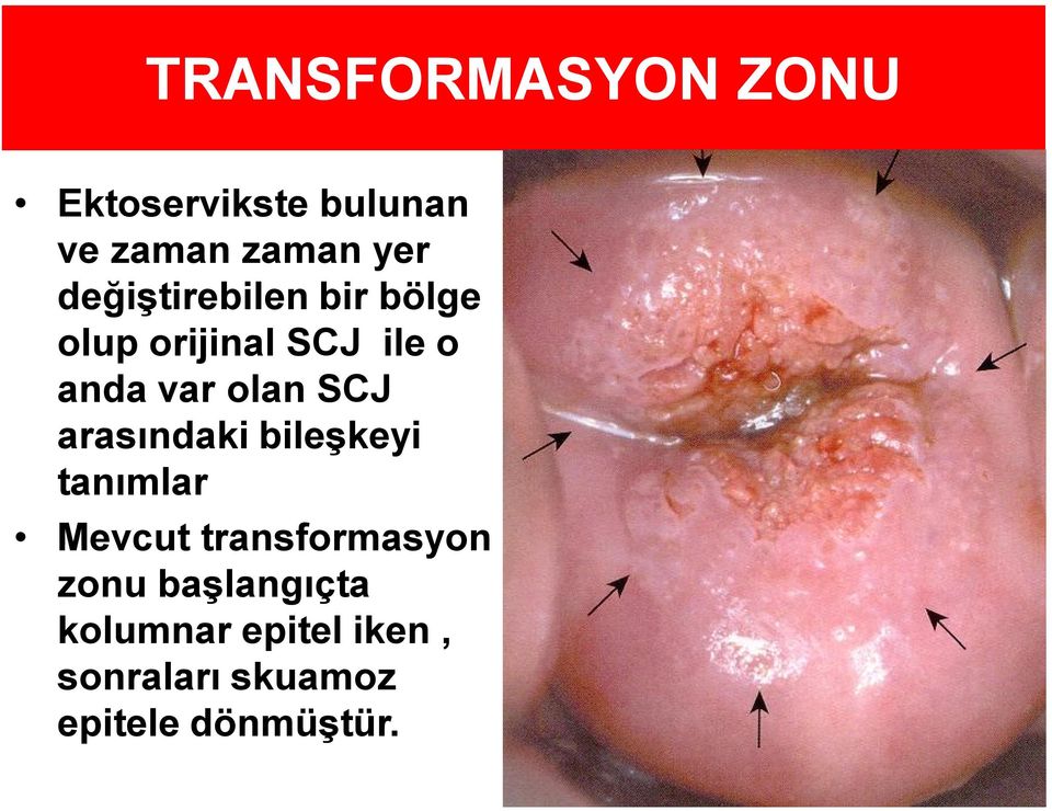 SCJ arasındaki bileşkeyi tanımlar Mevcut transformasyon zonu