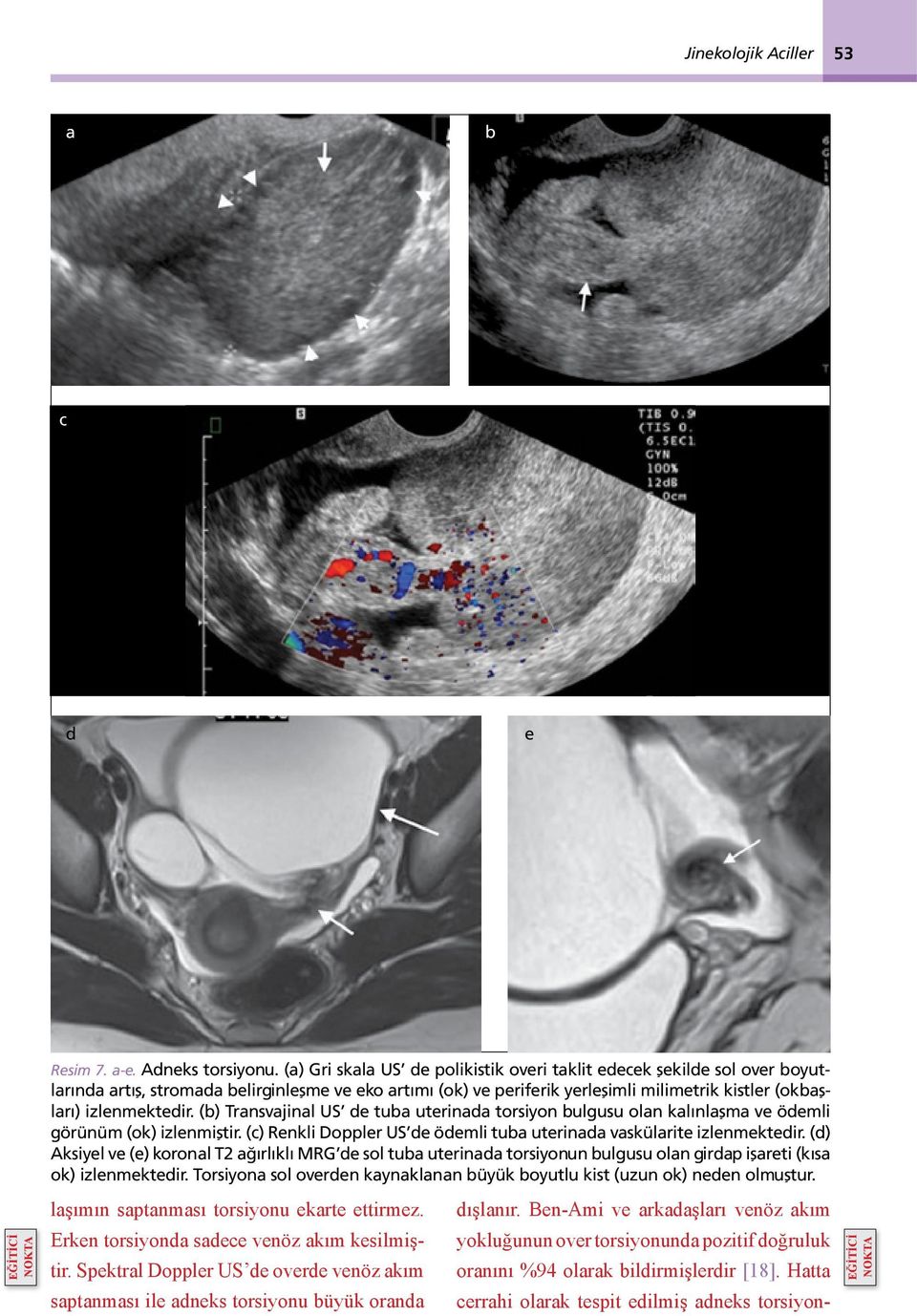 (b) Transvajinal US de tuba uterinada torsiyon bulgusu olan kalınlaşma ve ödemli görünüm (ok) izlenmiştir. (c) Renkli Doppler US de ödemli tuba uterinada vaskülarite izlenmektedir.