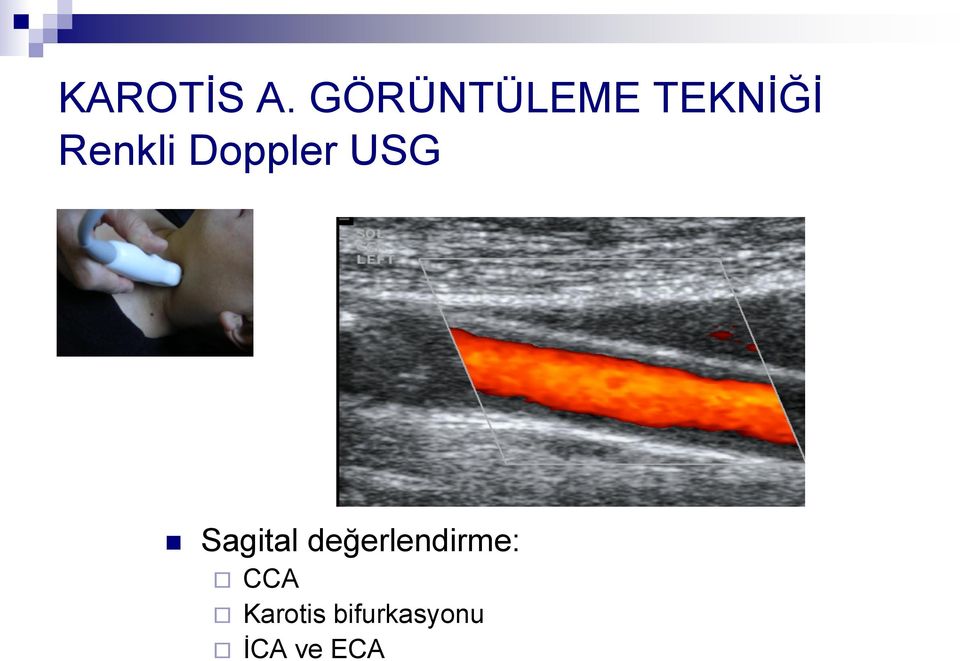 Doppler USG Sagital