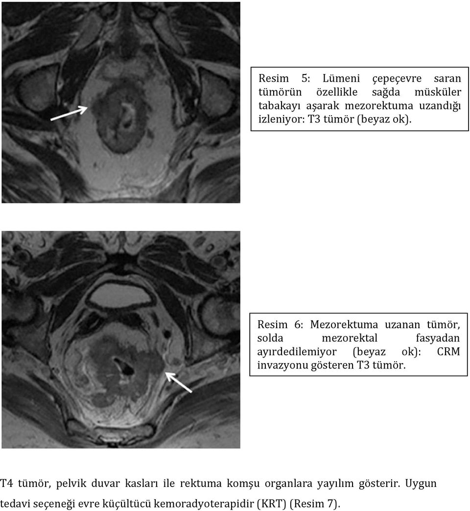 Resim 6: Mezorektuma uzanan tümör, solda mezorektal fasyadan ayırdedilemiyor (beyaz ok): CRM