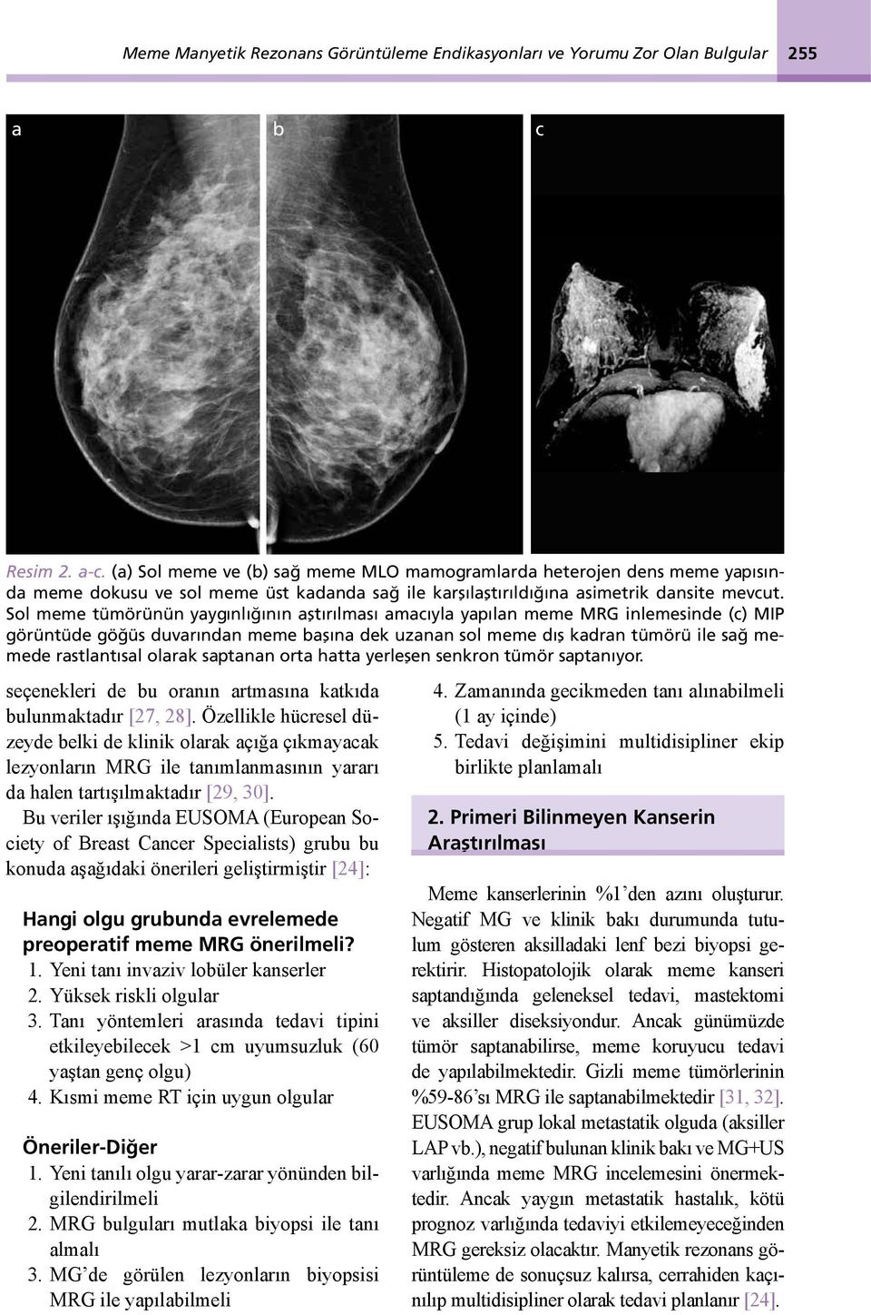 Sol meme tümörünün yaygınlığının aştırılması amacıyla yapılan meme MRG inlemesinde (c) MIP görüntüde göğüs duvarından meme başına dek uzanan sol meme dış kadran tümörü ile sağ memede rastlantısal