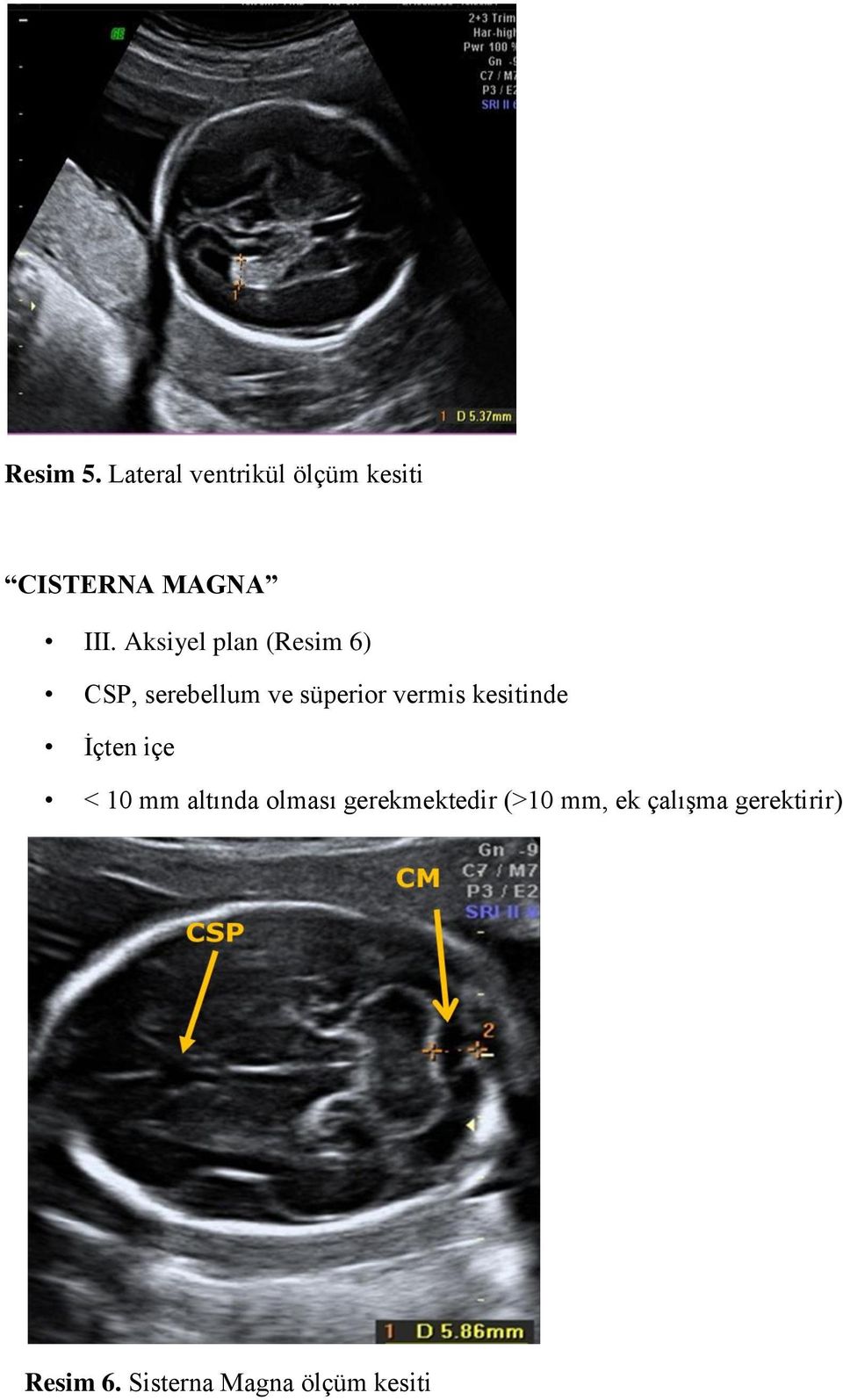 kesitinde İçten içe < 10 mm altında olması gerekmektedir