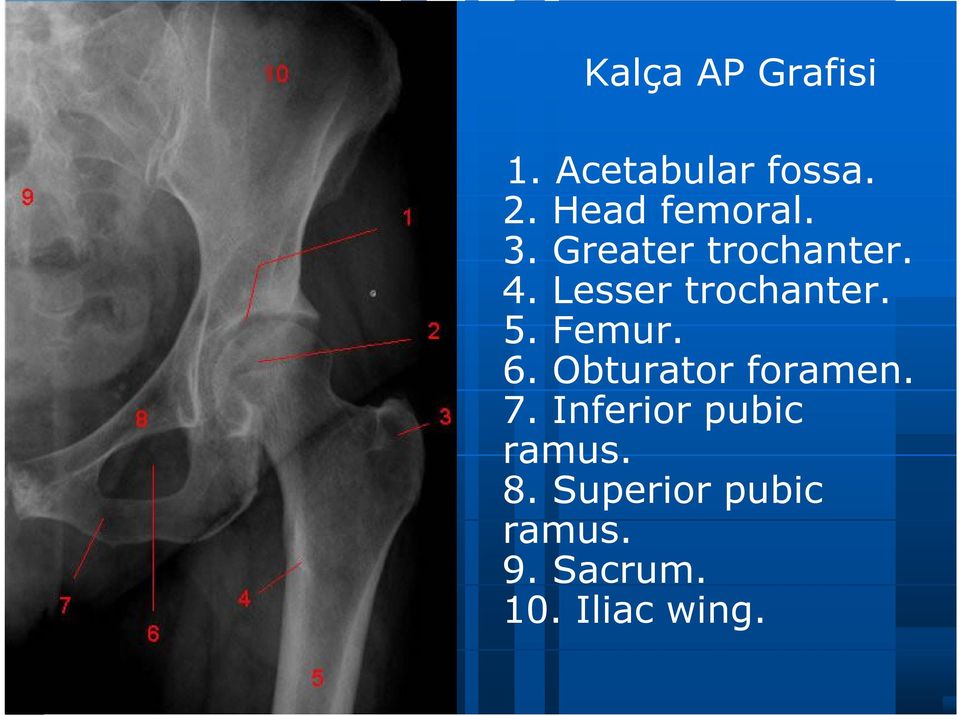 Lesser trochanter. 5. Femur. 6. Obturator foramen.