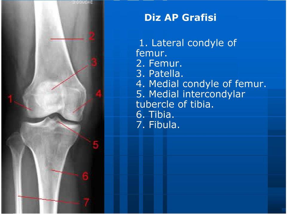 Patella. 4. Medial condyle of femur. 5.