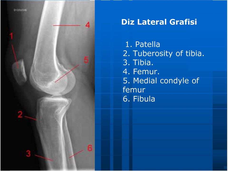 Tuberosity of tibia. 3.