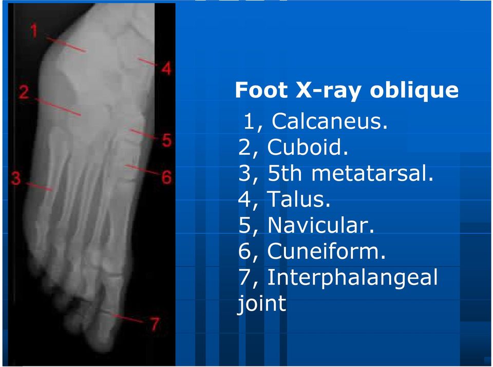 4, Talus. 5, Navicular.