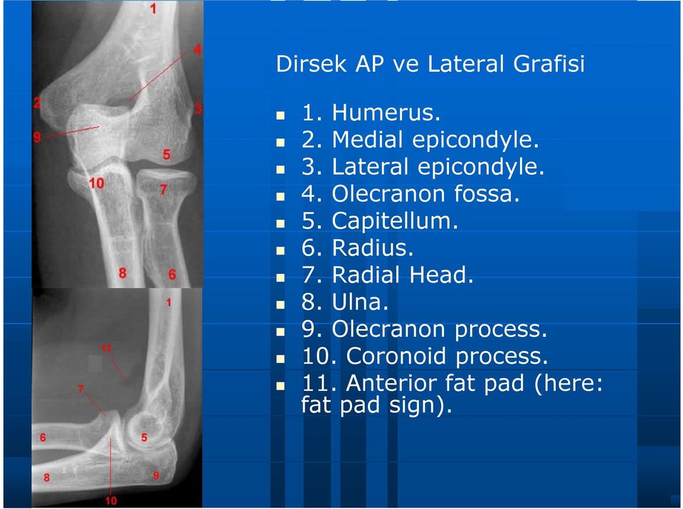 5. Capitellum. 6. Radius. 7. Radial Head. 8. Ulna. 9.