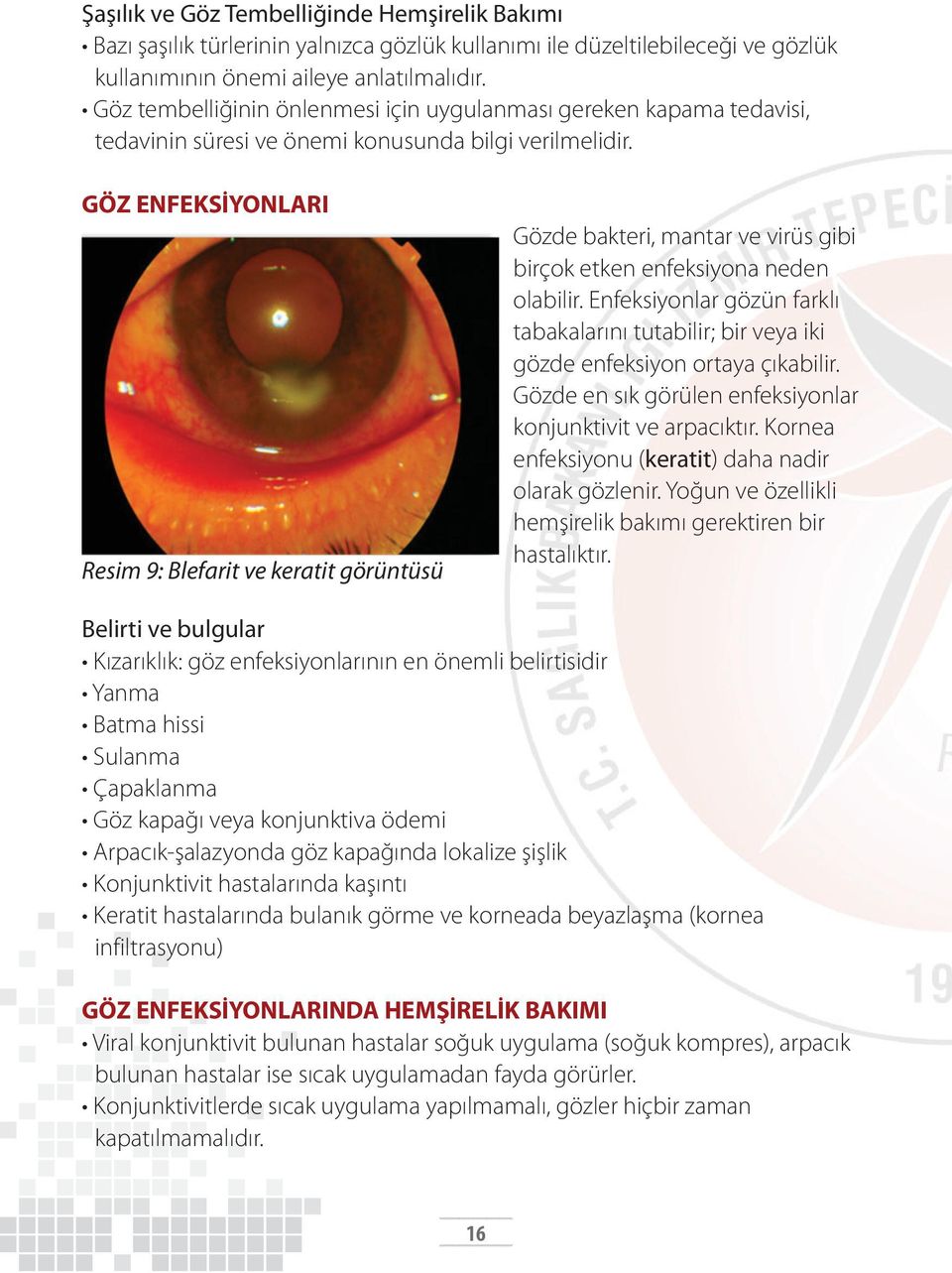 GÖZ ENFEKSİYONLARI Resim 9: Blefarit ve keratit görüntüsü Gözde bakteri, mantar ve virüs gibi birçok etken enfeksiyona neden olabilir.