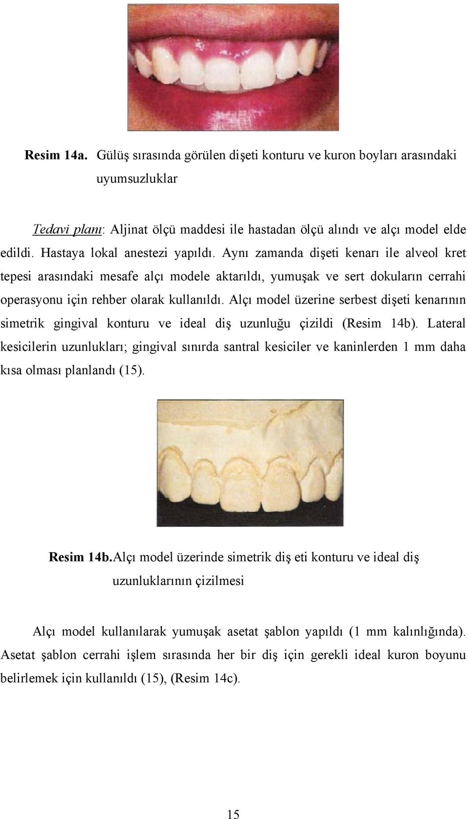 Alçı model üzerine serbest dişeti kenarının simetrik gingival konturu ve ideal diş uzunluğu çizildi (Resim 14b).