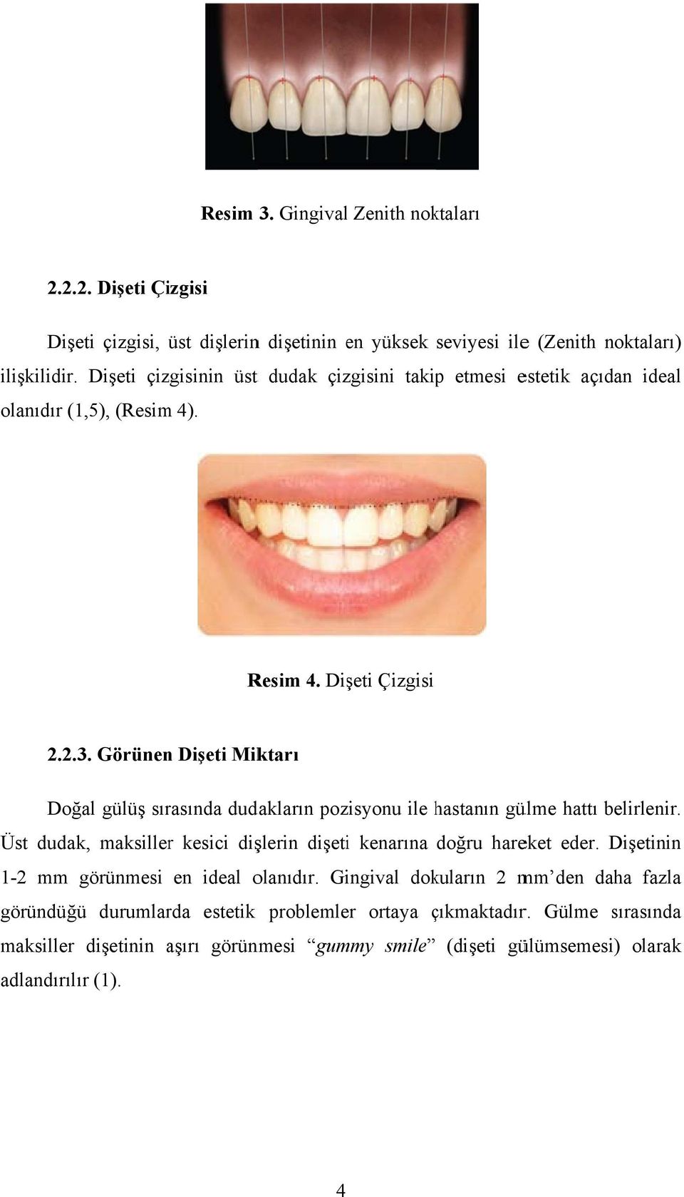 Görünenn Dişeti Miktarı Doğal gülüş sırasında dudakların pozisyonu ile hastanın h gülme hattı belirlenir. Üst dudak, maksillerr kesici dişlerin dişetii kenarına doğru hareket eder.