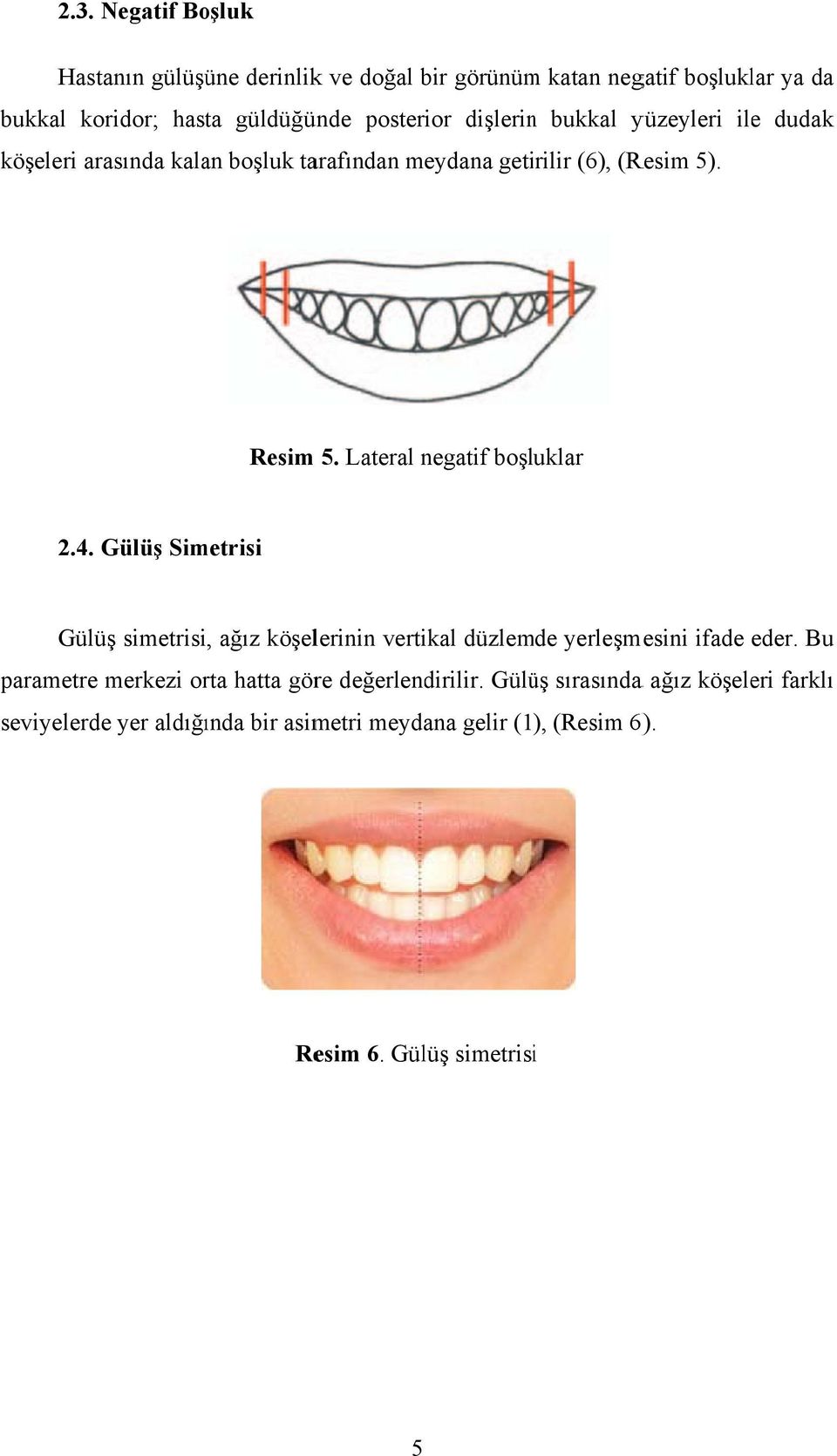 Lateral negatif boşluklar 2.4. Gülüş Simetrisi Gülüş simetrisi, ağız köşelerinin vertikal düzlemde yerleşmesini ifade eder.