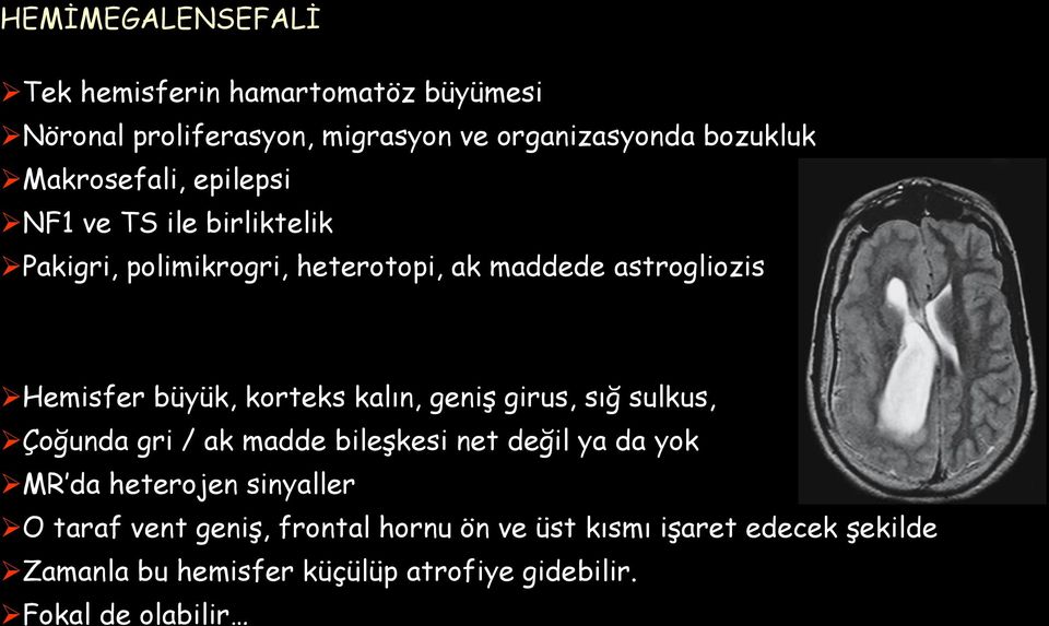 korteks kalın, geniş girus, sığ sulkus, Çoğunda gri / ak madde bileşkesi net değil ya da yok MR da heterojen sinyaller O