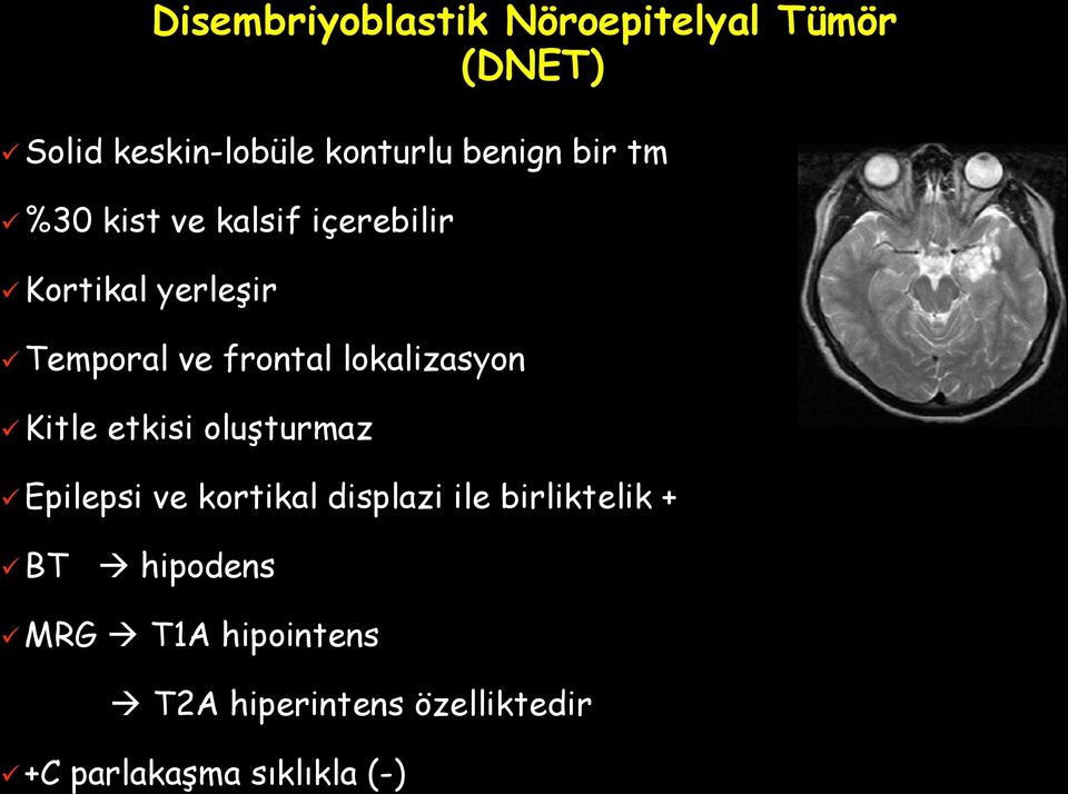 lokalizasyon Kitle etkisi oluşturmaz Epilepsi ve kortikal displazi ile