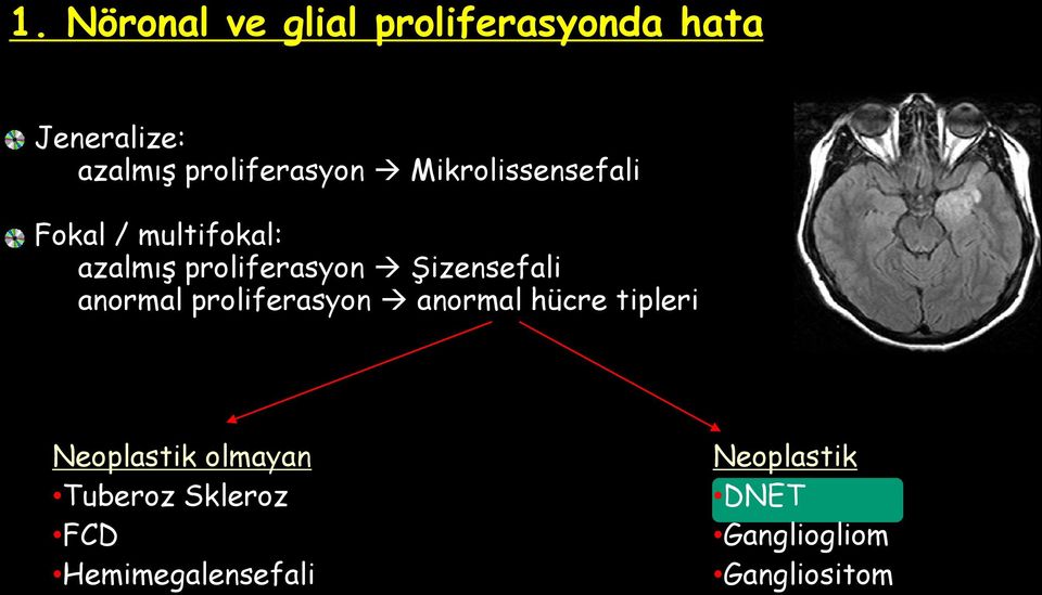 proliferasyon Şizensefali anormal proliferasyon anormal hücre tipleri