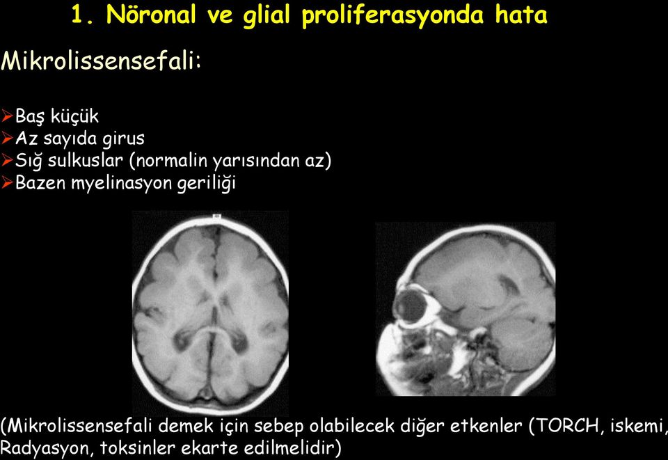 myelinasyon geriliği (Mikrolissensefali demek için sebep olabilecek