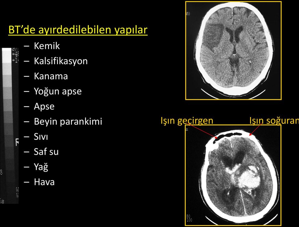 apse Apse Beyin parankimi Sıvı