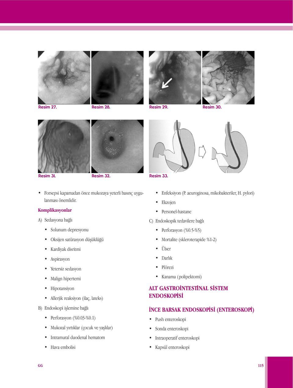 Endoskopi işlemine bağlı Perforasyon (%0.03-%0.1) Mukozal yırtıklar (çocuk ve yaşlılar) Intramural duodenal hematom Hava embolisi Enfeksiyon (P. aeuroginosa, mikobakteriler, H.