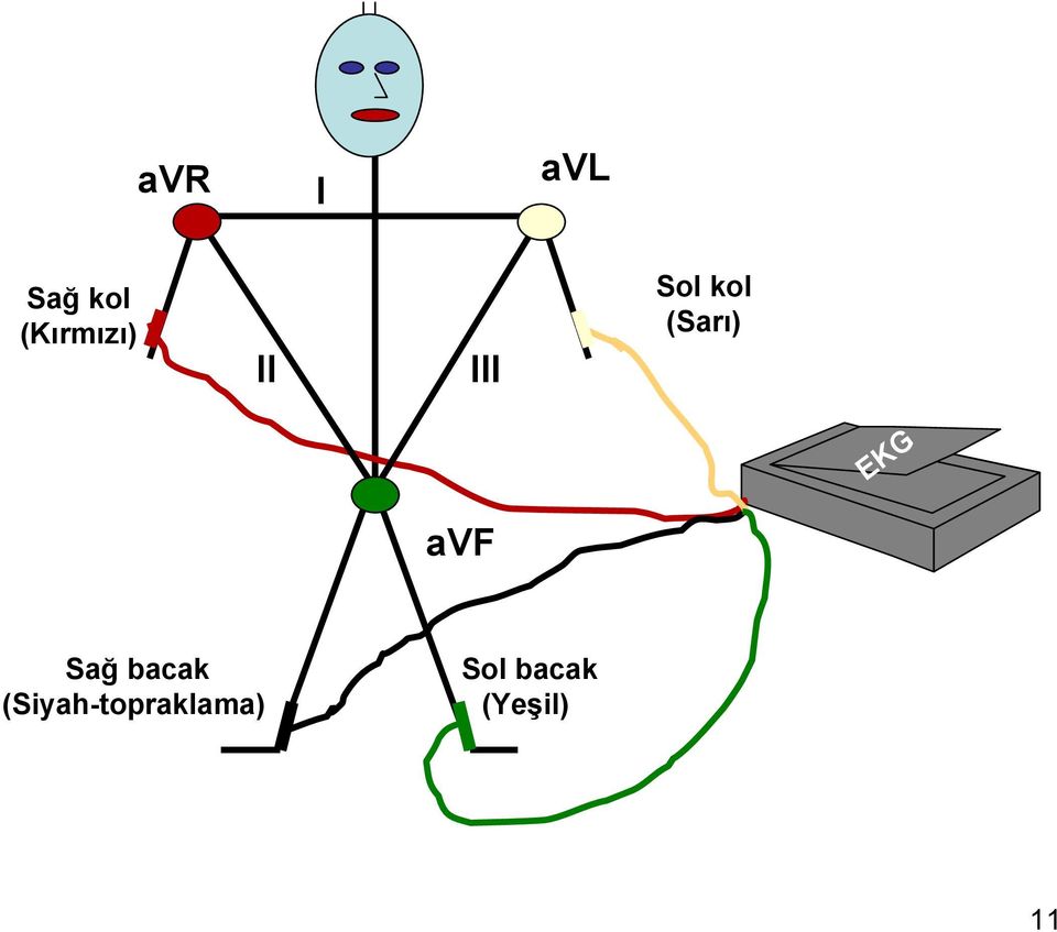 (Sarı) EKG avf Sağ bacak