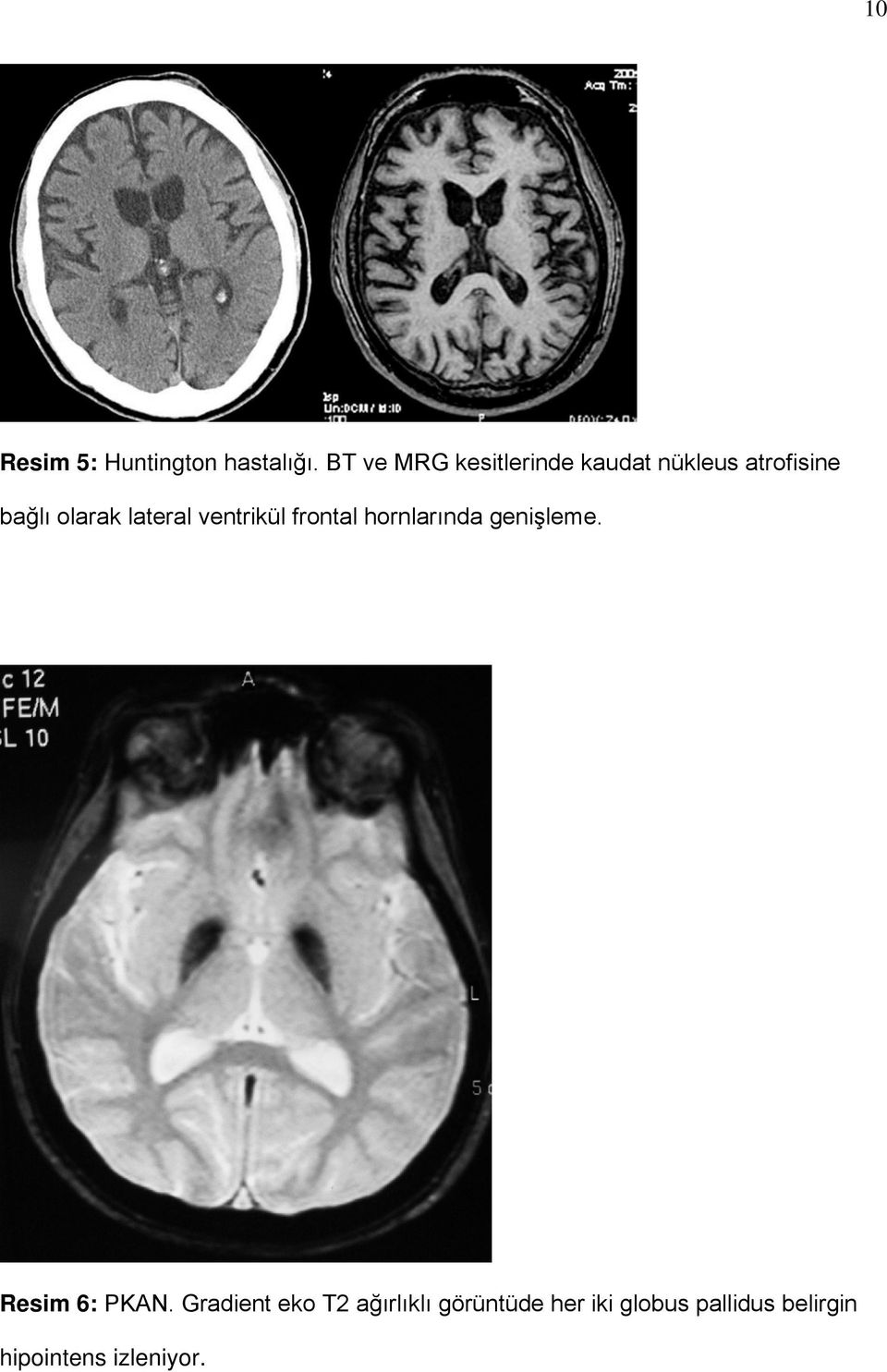 lateral ventrikül frontal hornlarında genişleme. Resim 6: PKAN.