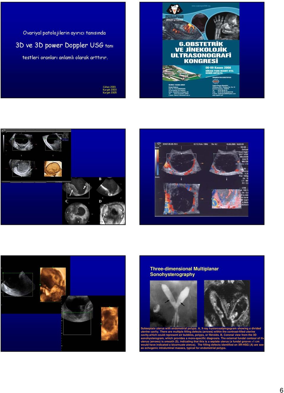 There are multiple filling defects (arrows) within the contrast-filled uterine cavity,which could represent air bubbles, polyps, or fibroids.