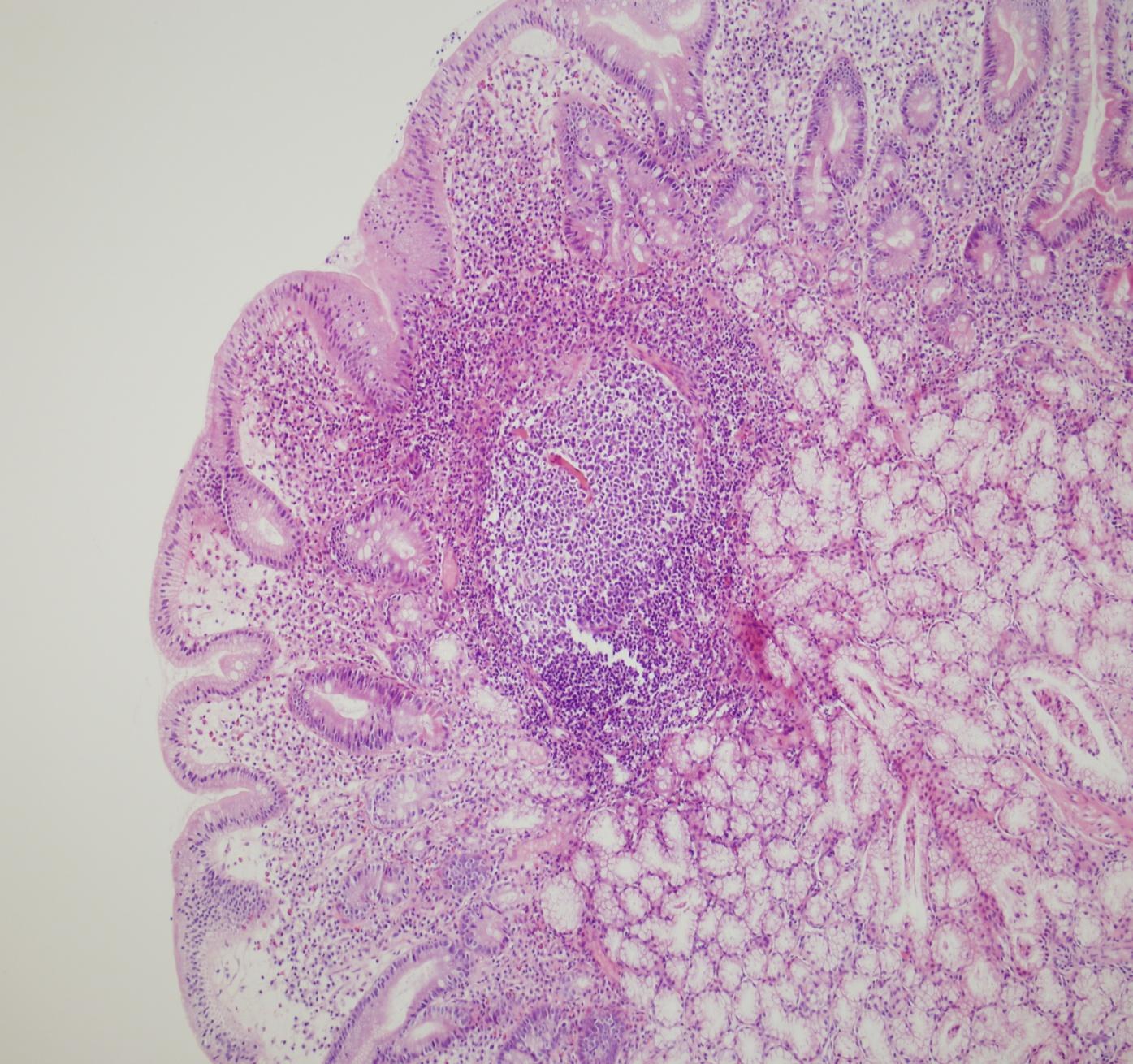 Oryantasyon Duodenum: Peptik hasarlanma Brunner