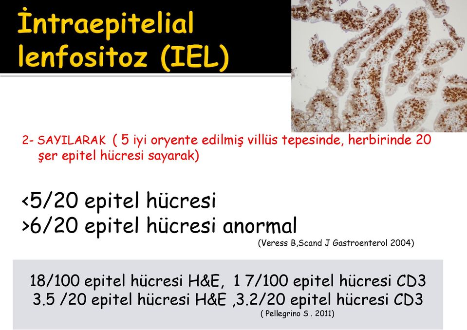 (Veress B,Scand J Gastroenterol 2004) 18/100 epitel hücresi H&E, 1 7/100
