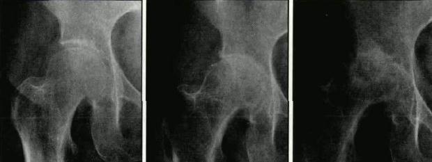 Kalça Osteoartriti Tanım Tanım ve Etiyoloji Her ne kadar birçok değişik faktörle başlasa da, genetik, gelişimsel, metabolik ve travmatik gibi, OA hastalığı eklemin çevresindeki tüm dokuları etkiler