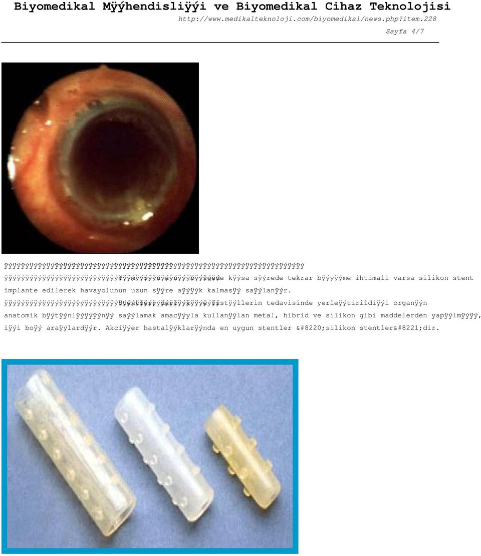 5rede tekrar b 0 7 0 5y 0 7 0 5me ihtimali varsa silikon stent implante edilerek havayolunun uzun s 0 7 0 5re a 0 7 0 5 0 7 0 5k kalmas 0 7 0 5 sa 0 7 0 5lan 0 7 0 5r.