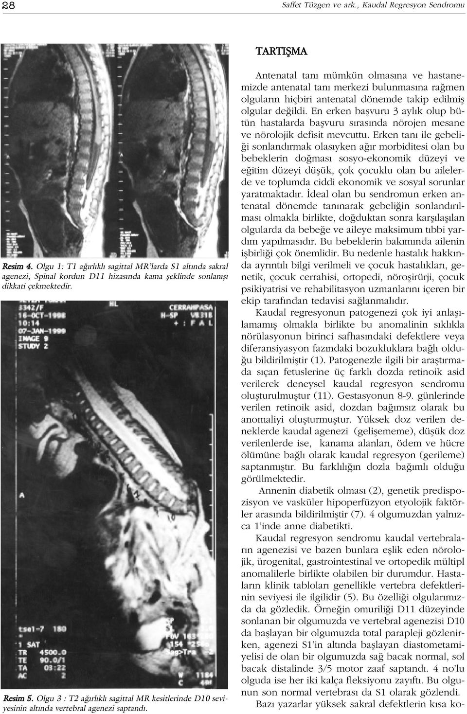 Olgu 3 : T2 a rl kl sagittal MR kesitlerinde D10 seviyesinin alt nda vertebral agenezi saptand.