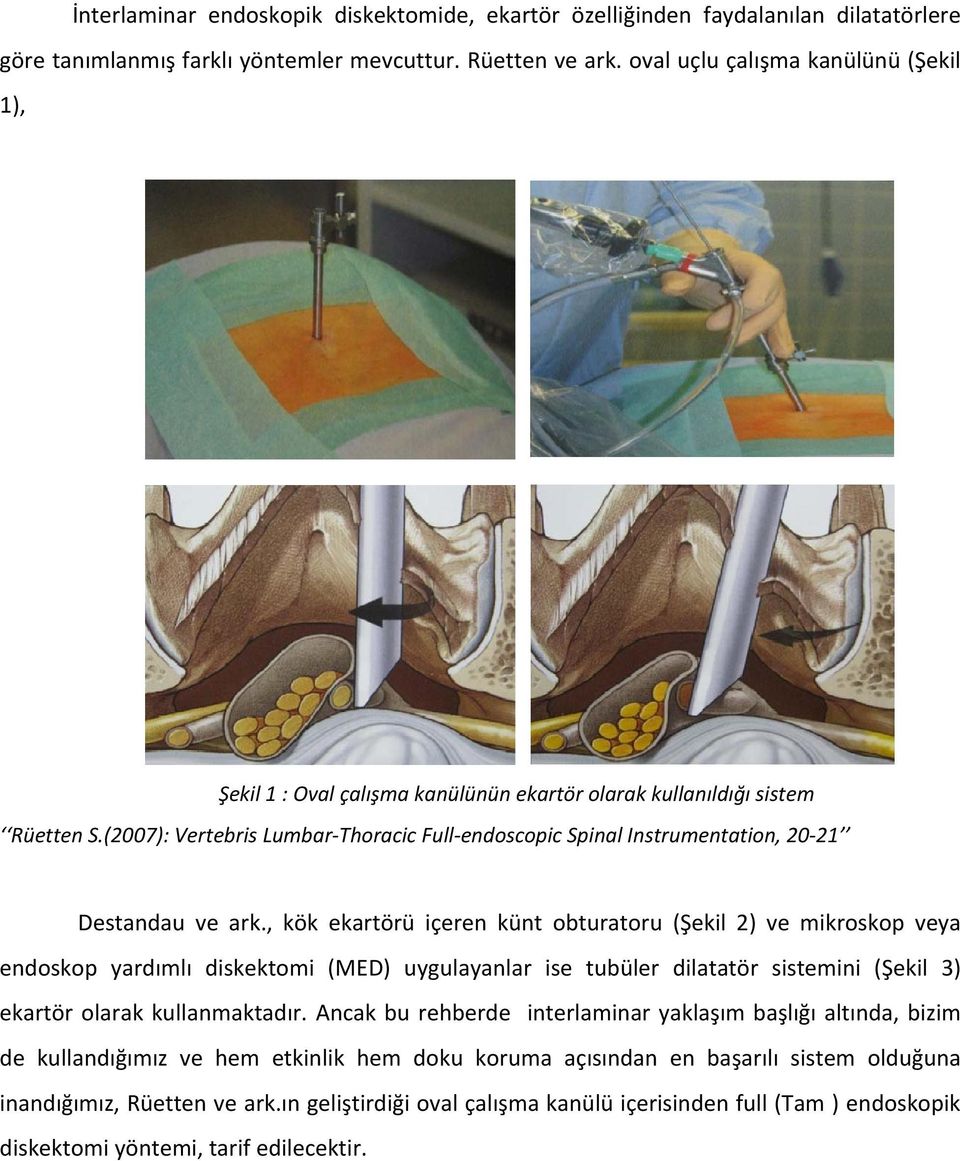 (2007): Vertebris Lumbar-Thoracic Full-endoscopic Spinal Instrumentation, 20-21 Destandau ve ark.