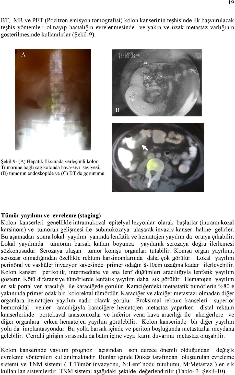 C Tümör yayılımı ve evreleme (staging) Kolon kanserleri genellikle intramukozal epitelyal lezyonlar olarak başlarlar (intramukozal karsinom) ve tümörün gelişmesi ile submukozaya ulaşarak invaziv